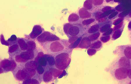 Grundprincipper i udredning af den onkologiske patient - FNA vepithelial, glandulært, væv