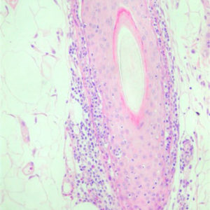 Figur 4 – Histologisk udsnit af hårfollikel, hvor der ses lokal infiltration af folliklens yderste lag med lymfocytter (Foto: Joan Rest).
