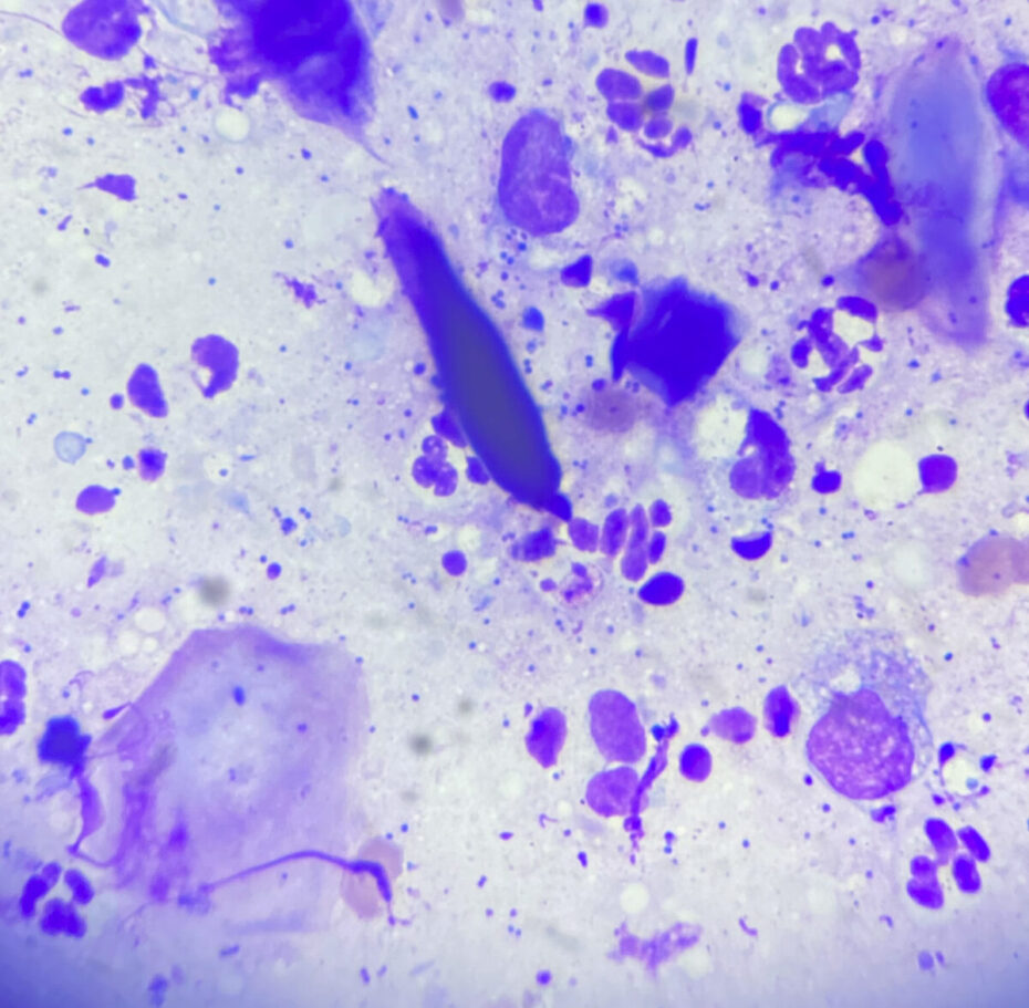 Aftrykspræparat af en sekundær bakteriel infektion.