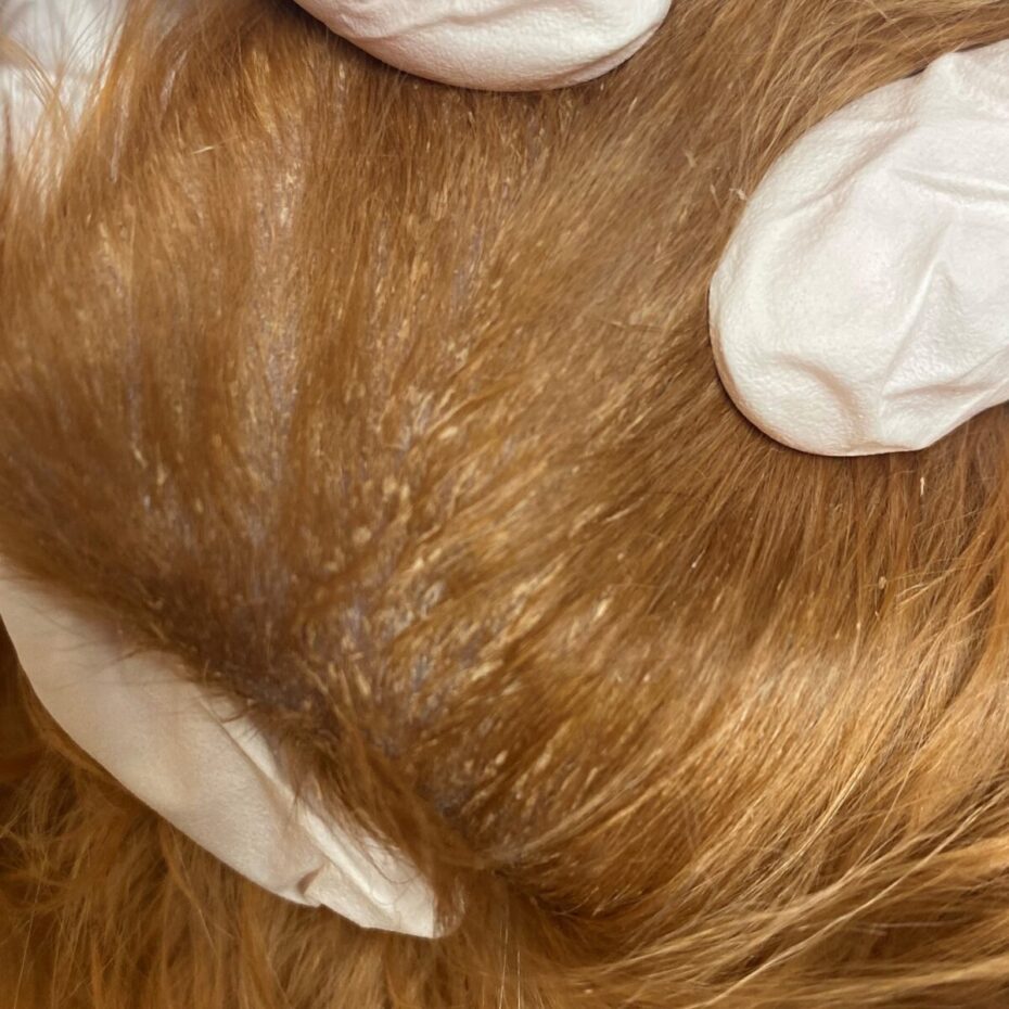 Figur 5 . Follikulære cast som er meget almindelig for sygdommen SA.